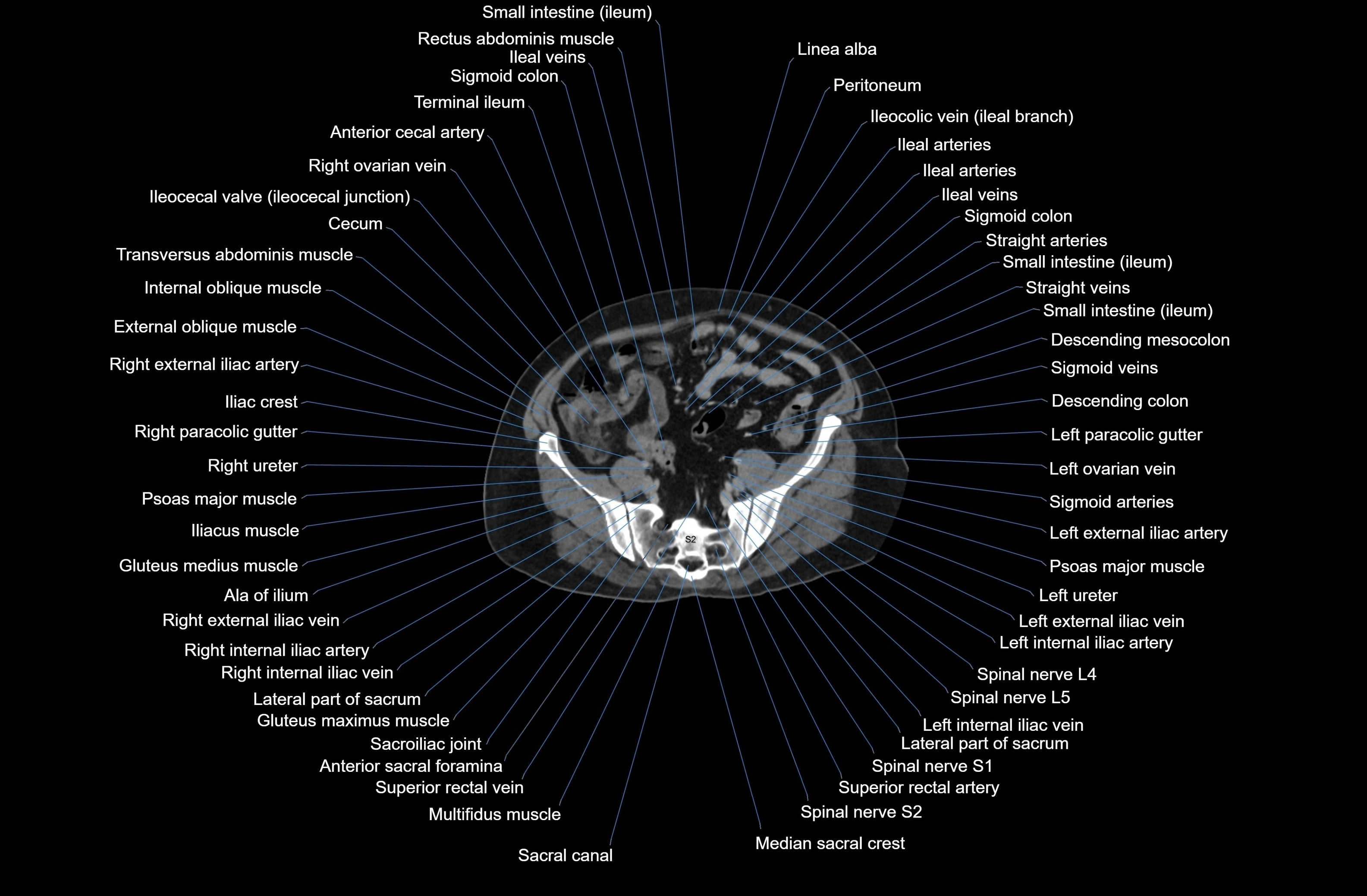 CT Abdomen axial cross sectional anatomy labelled radiology image-00070.webp